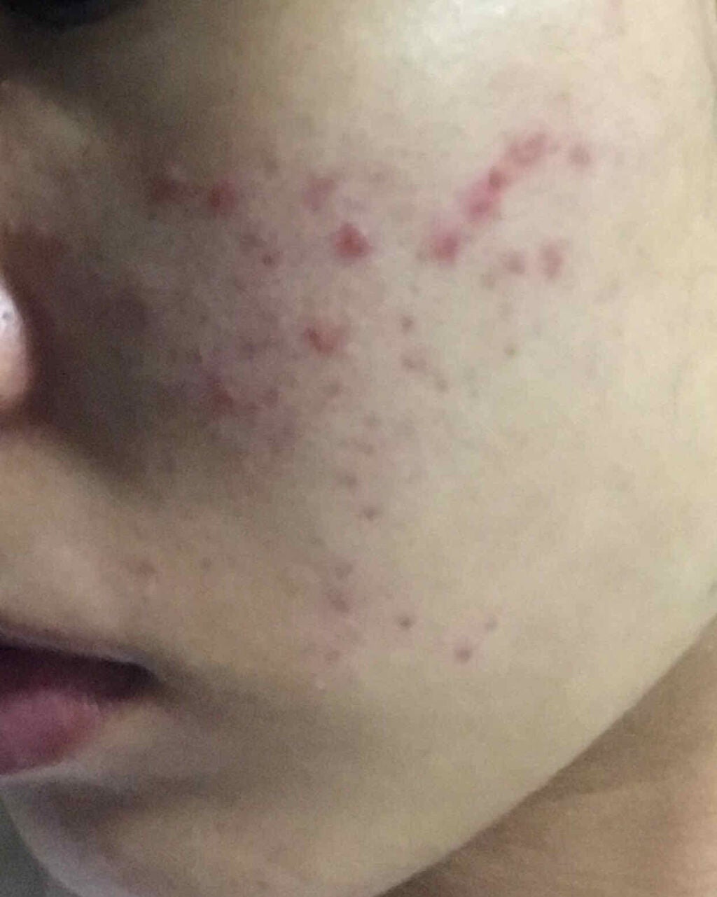 薬用 しみ 集中対策 美容液/メラノCC/美容液を使ったクチコミ(1枚目)