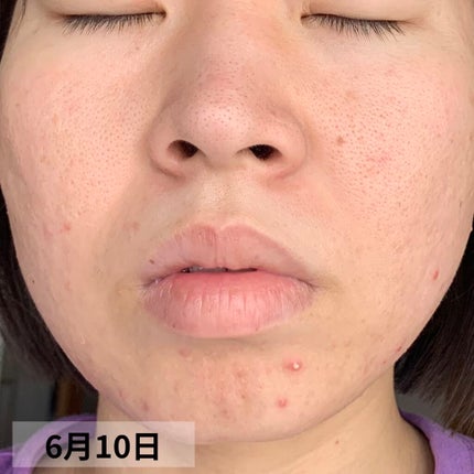 PURE ROSEHIP SEED OIL/Life-flo/フェイスオイルを使ったクチコミ(10枚目)