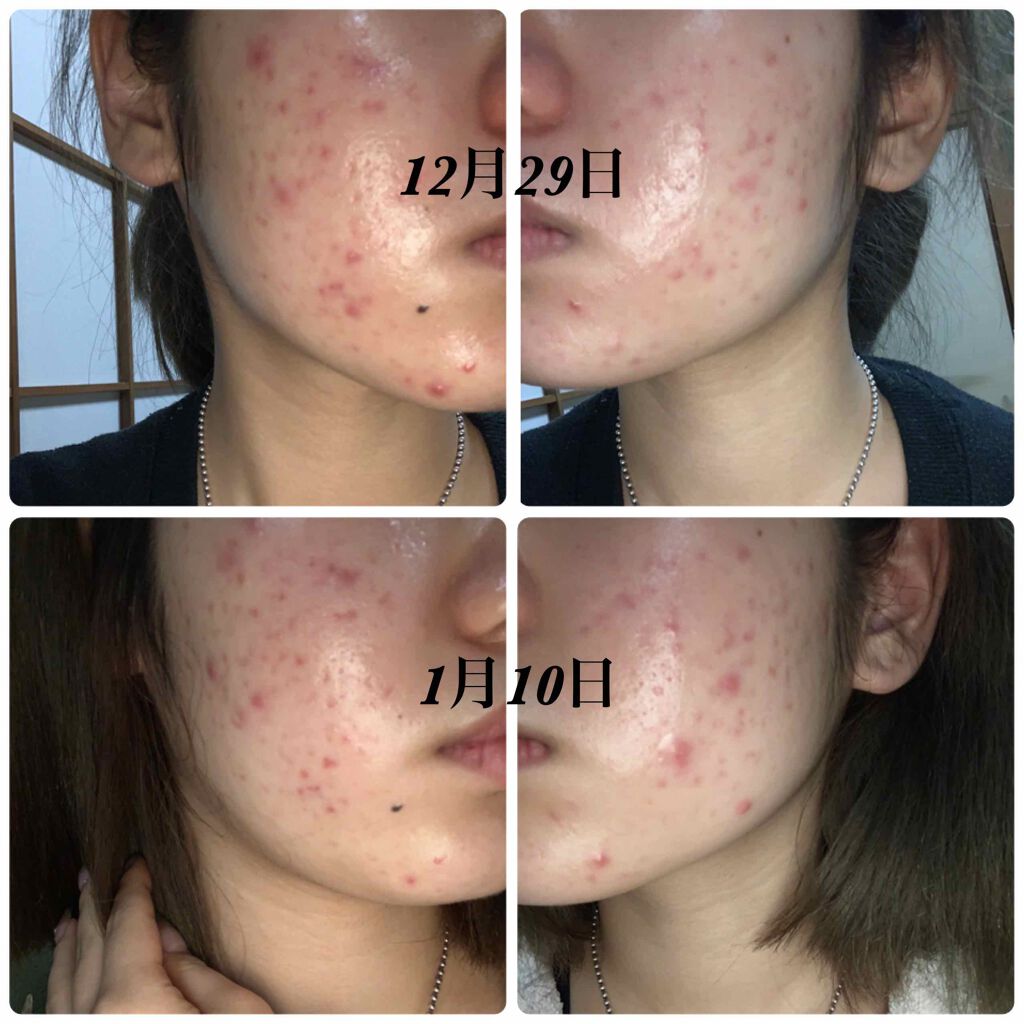 ❄️結晶❄️ on LIPS 「自分の記録用としてと同じ悩みを抱えてる方の少しでもお力になれれ..」(3枚目)