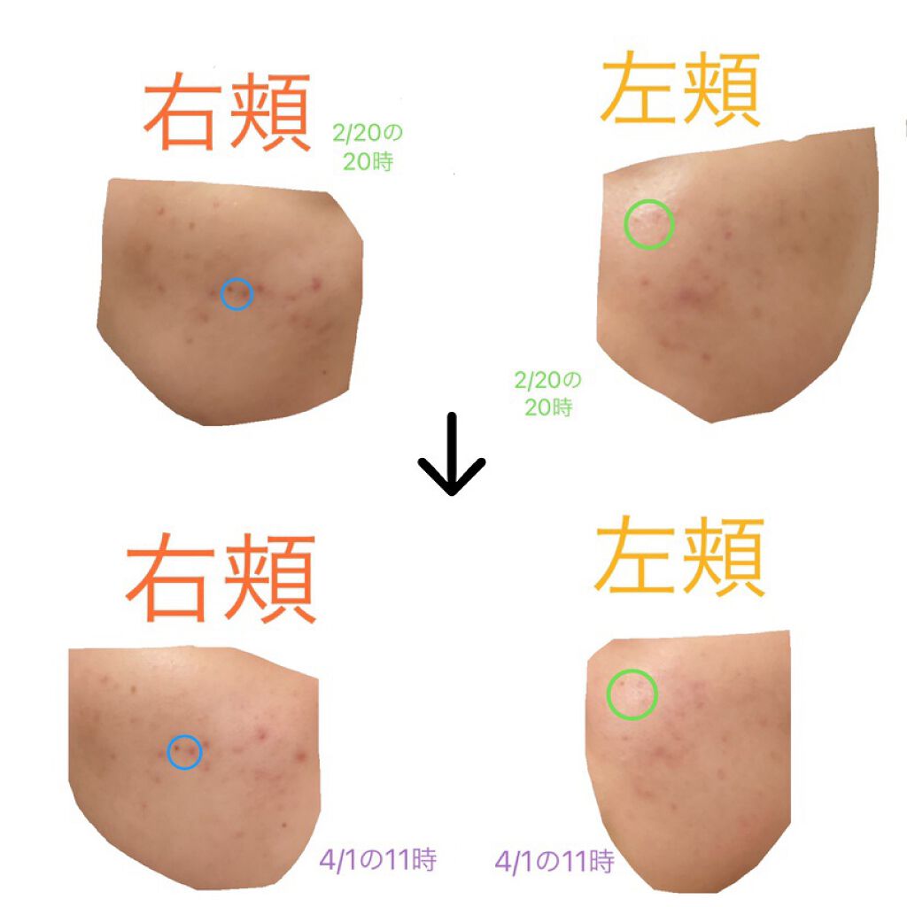 薬用 しみ 集中対策 美容液/メラノCC/美容液を使ったクチコミ（2枚目）