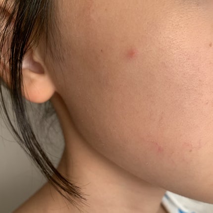 極薄透明パッチ nikipa!/金冠堂/にきびパッチを使ったクチコミ(6枚目)