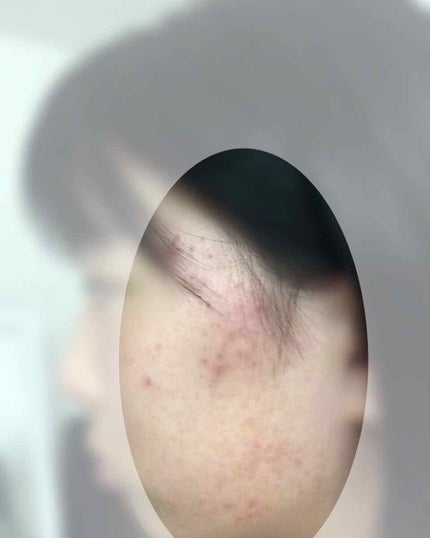 しゅ~ on LIPS 「閲覧ありがとうございます😖新中3の中学生です!!最近ニキビとニ..」(2枚目)