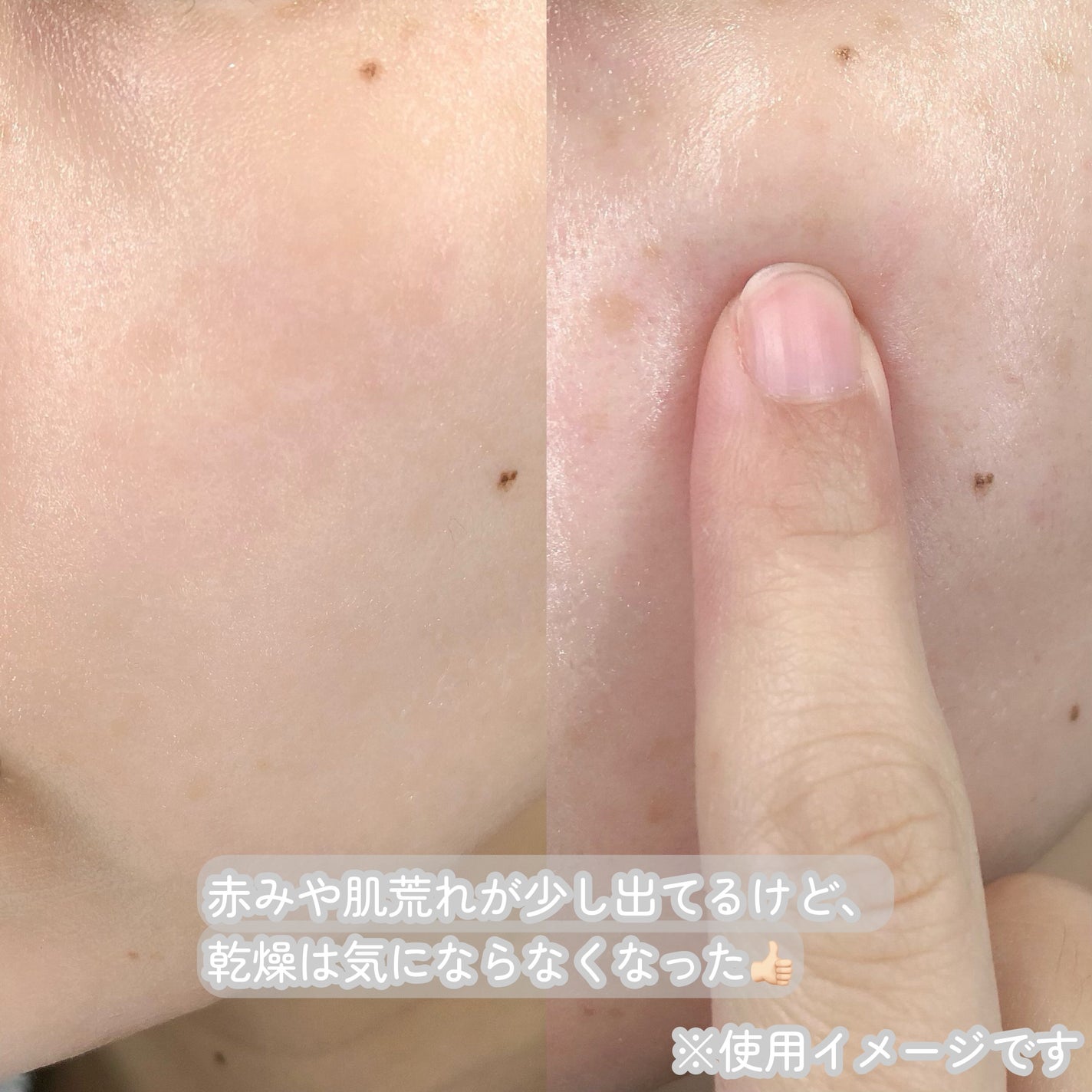 グルカミューンクリーム/VT/フェイスクリームを使ったクチコミ(4枚目)