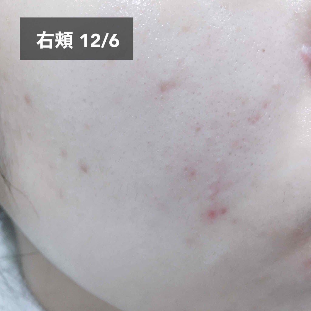 もち on LIPS 「ニキビ治療結果こんにちは、こんばんは!もちです☺️今回は、以前..」(4枚目)