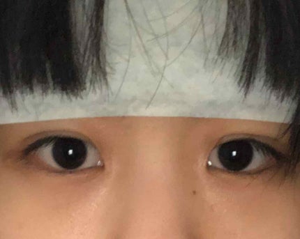 二重整形/その他を使ったクチコミ(2枚目)