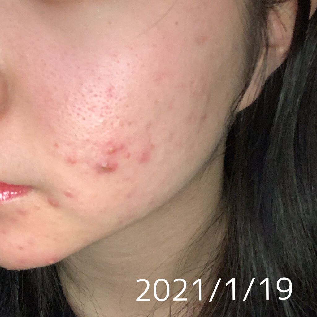 潤浸保湿 化粧水 III とてもしっとり/キュレル/化粧水を使ったクチコミ（2枚目）