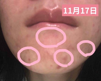 オードムーゲ 薬用ローション(ふきとり化粧水)/オードムーゲ/拭き取り化粧水を使ったクチコミ(3枚目)