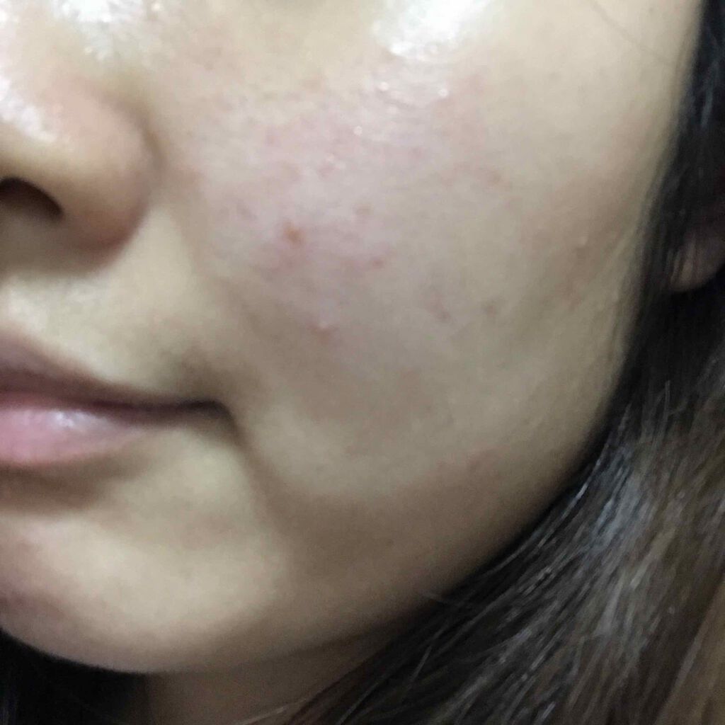 ペアアクネクリームW(医薬品)/ペア/その他を使ったクチコミ（2枚目）