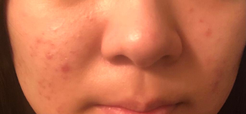 みおん on LIPS 「みなさん助けてください…ニキビ跡がこんなに残ってます😢これでも..」(2枚目)