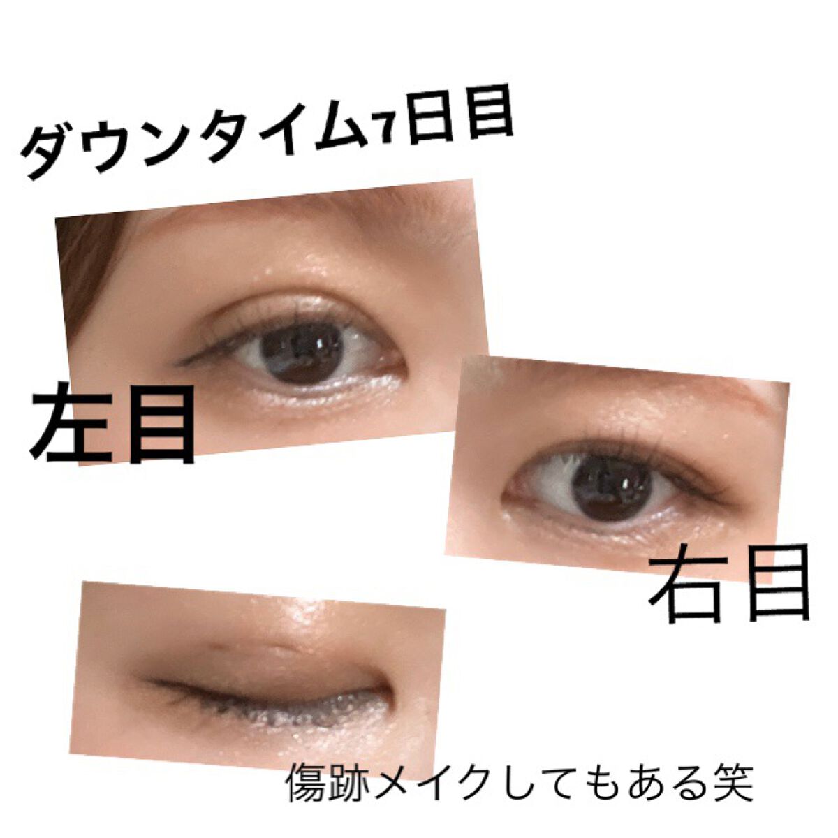 二重整形/その他を使ったクチコミ（1枚目）