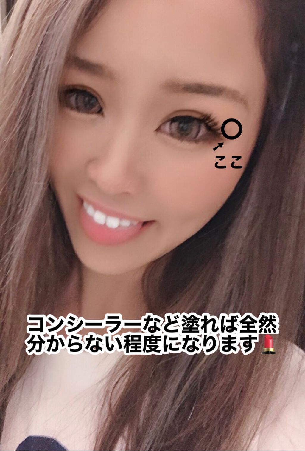 ひまわり on LIPS 「私が顔のほくろを19個取ったお話📖お顔失礼します🙇♀️前の写..」(3枚目)