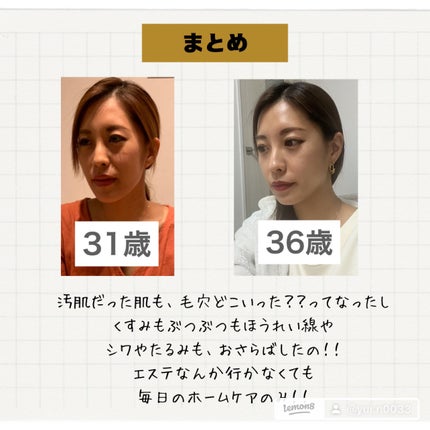 ゆい\\37歳美肌づくりの先生// on LIPS 「エステや皮膚科なし!!365日のホームケアだけでお肌がみるみる..」(5枚目)