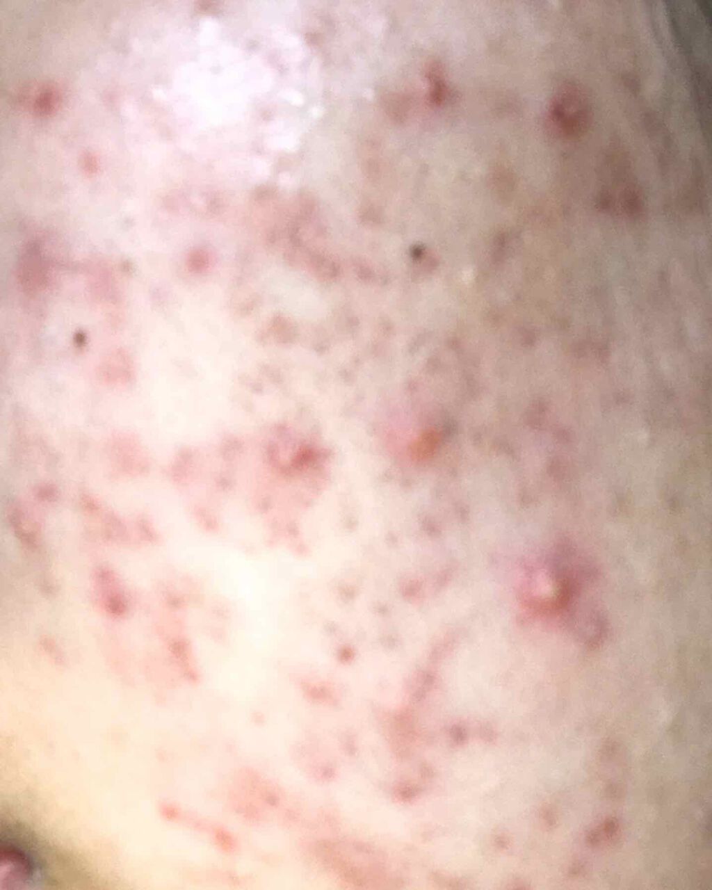 ð§ž on LIPS ããããã®è·¡ãèµ€ã¿ãæ¶ããã«æ©ãã§ããŸãâ¹ïž3幎ã»ã©ç®èç§ã§ãã¿..ãïŒ3æç®ïŒ