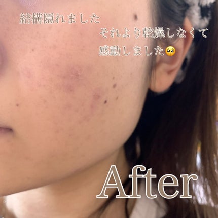 【旧】ディオールスキン フォーエヴァー スキン コレクト コンシーラー/Dior/リキッドコンシーラーを使ったクチコミ(6枚目)