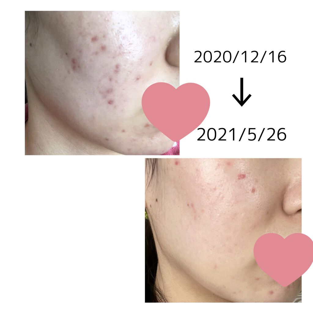 薬用 クリアローション M(しっとりタイプ)/オルビス/化粧水を使ったクチコミ（1枚目）