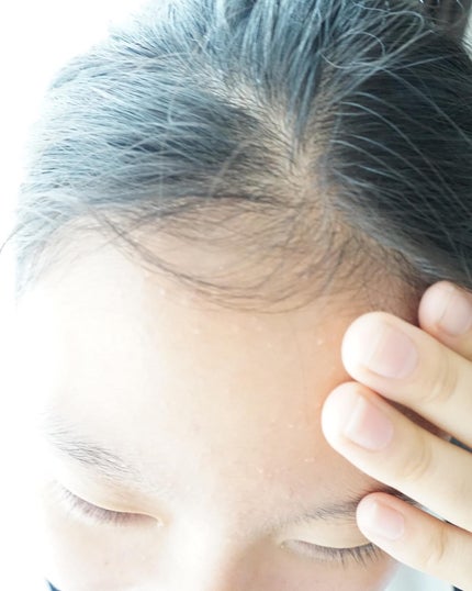 アクネケア ジェル乳液 <医薬部外品>/ファンケル/乳液を使ったクチコミ(7枚目)