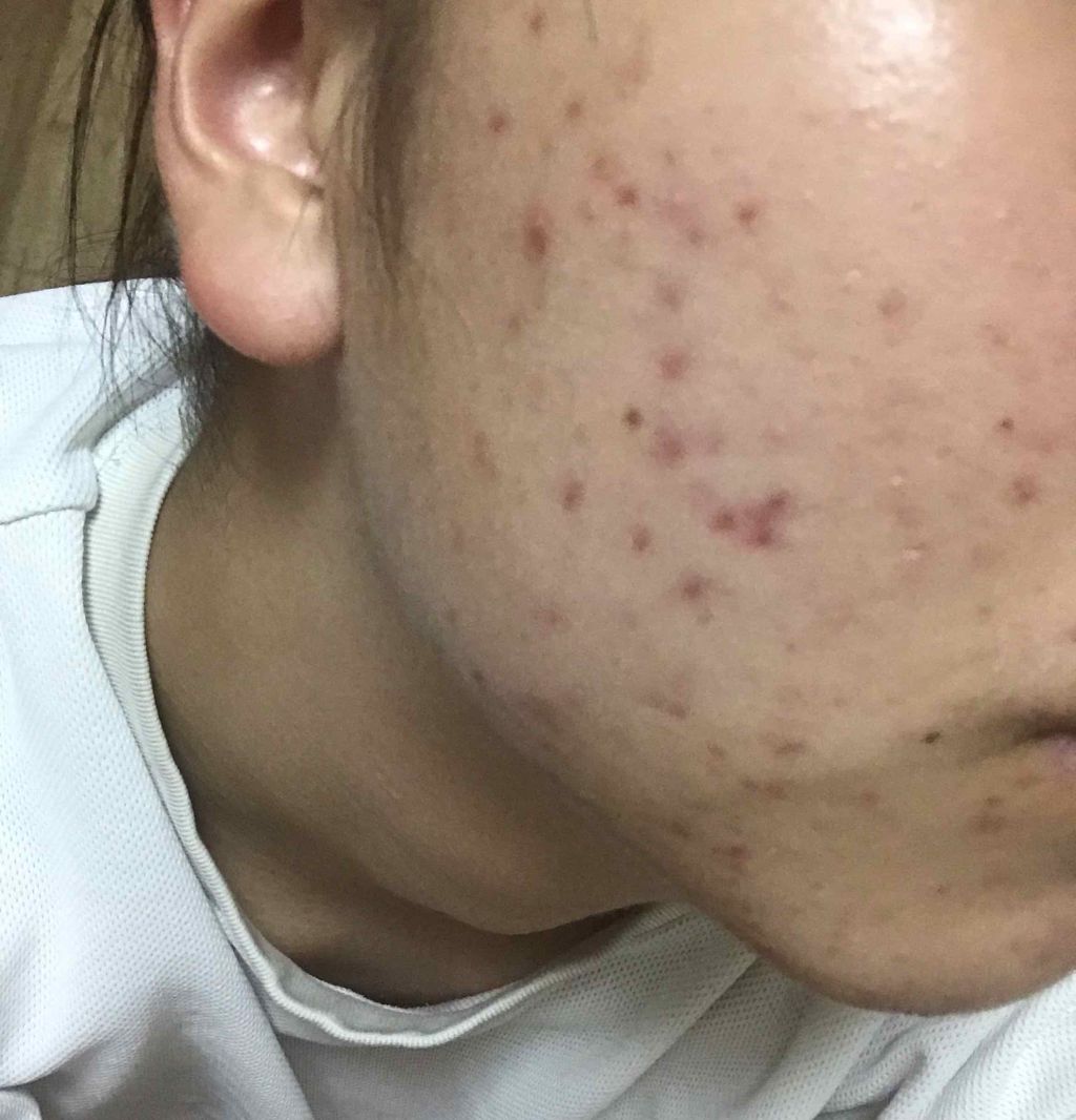 薬用しみ対策 美白化粧水 メラノccの口コミ 汚いお肌すみません 本当にすみま By Nemi 脂性肌 10代後半 Lips