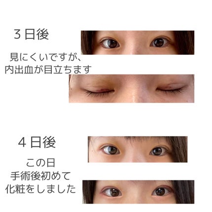 二重整形/その他を使ったクチコミ(2枚目)