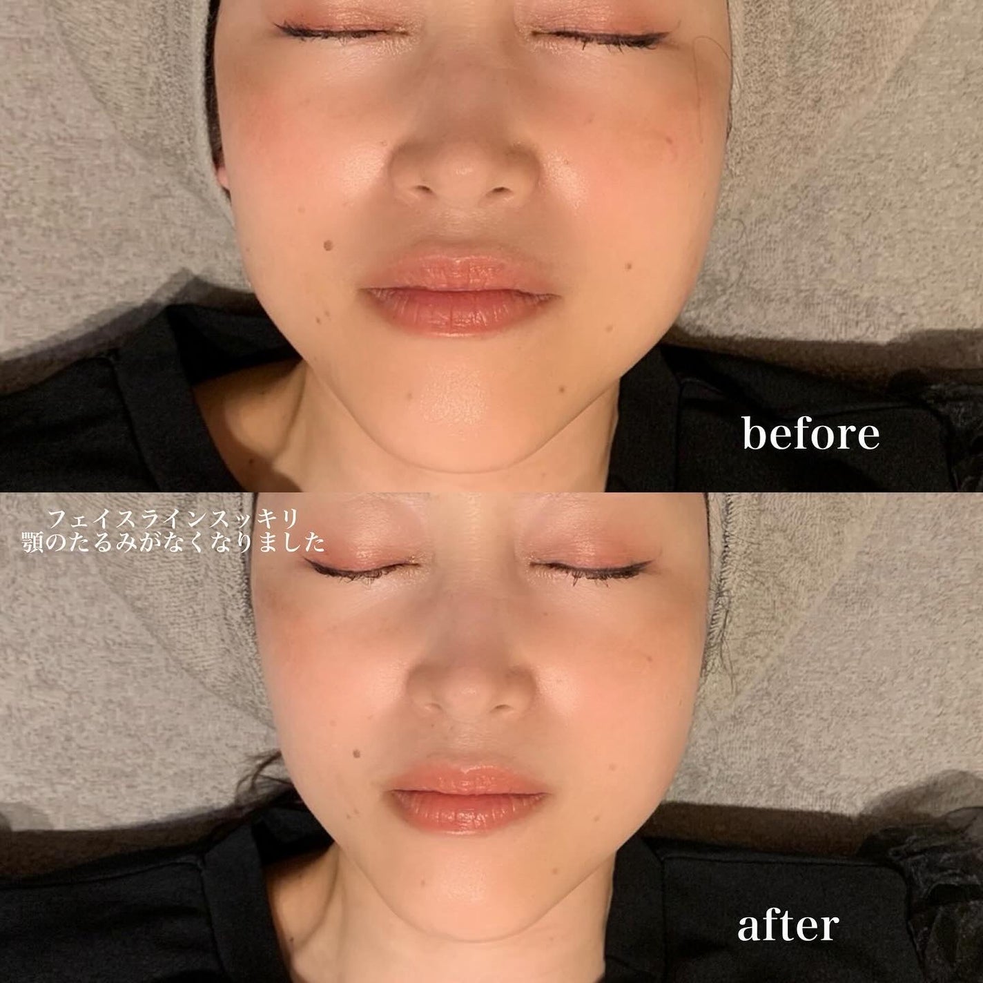 こはる on LIPS 「次世代のハイフ受けてきたよ♡小顔と美肌が同時に叶うサーマルフラ..」(3枚目)