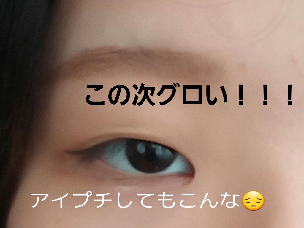 二重整形/その他を使ったクチコミ（3枚目）