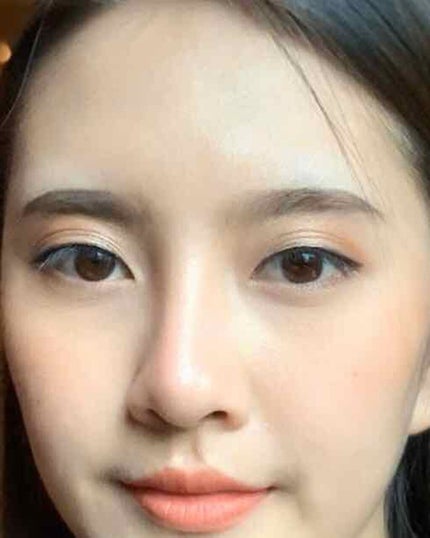 アクネケア エマルジョン R/d プログラム/乳液を使ったクチコミ(4枚目)