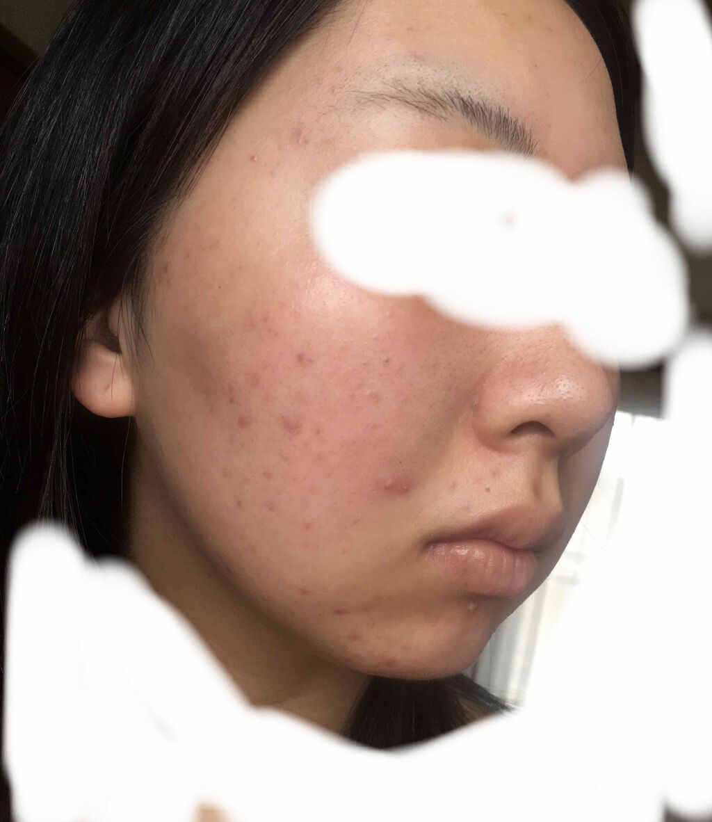 デュアック配合ゲル/ポーラファルマ/その他を使ったクチコミ（3枚目）