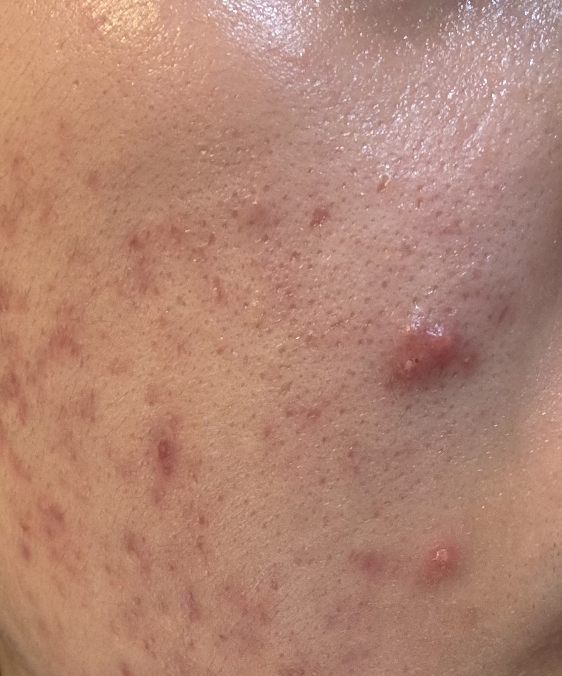 マジックティーツリーオイル/ブラン/フェイスオイルを使ったクチコミ（1枚目）