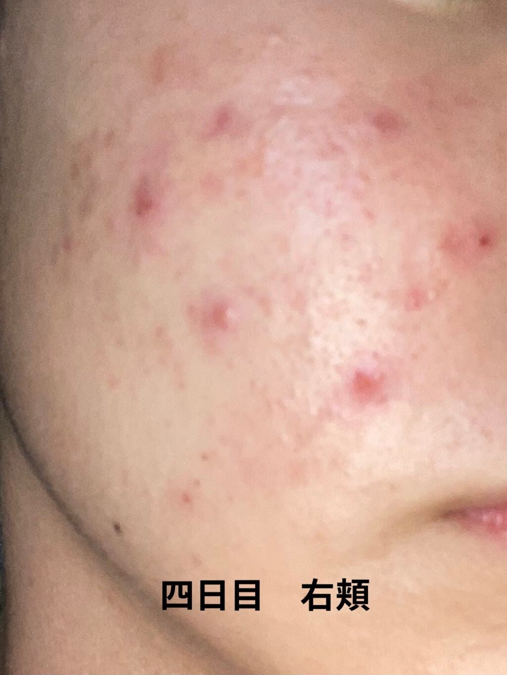 じぇーけー on LIPS 「私は中学2年生の始め頃からニキビが増え始めて、気になって潰した..」(8枚目)