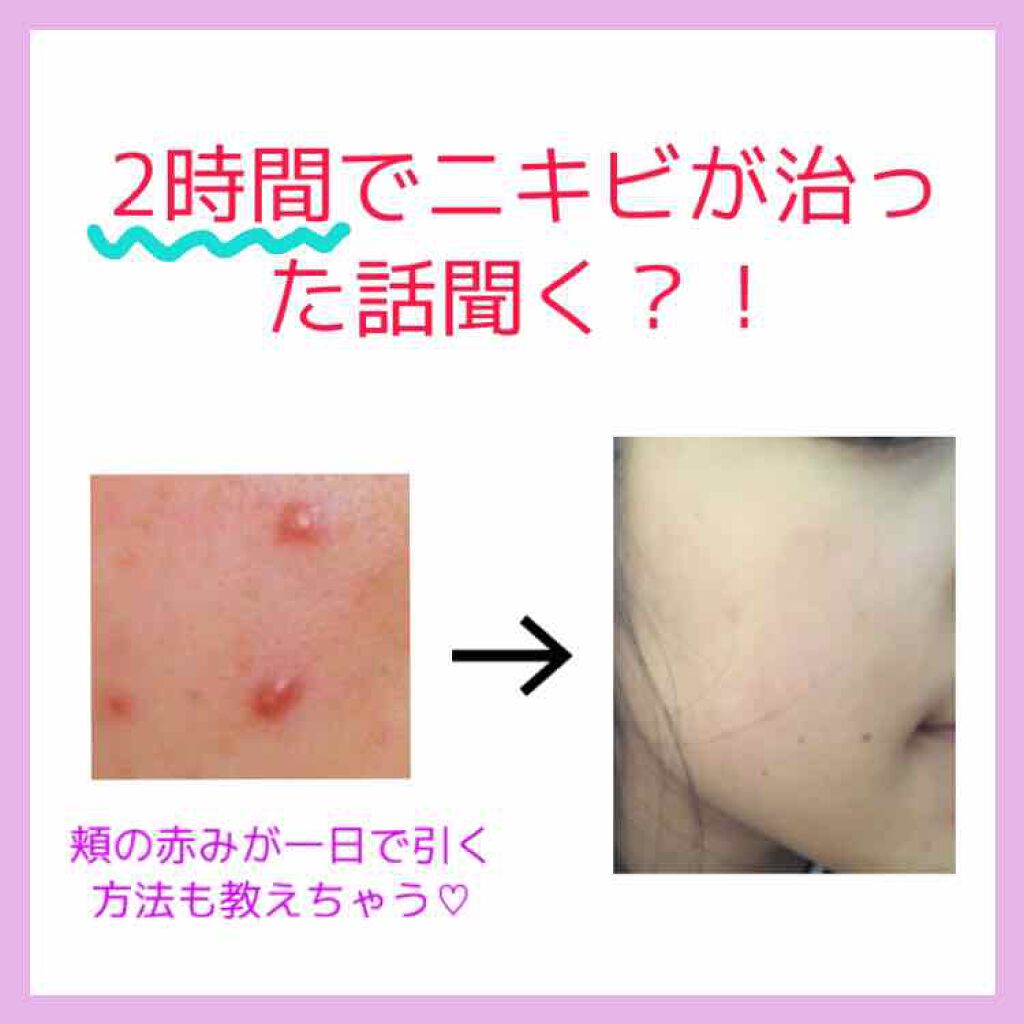 ACケア/ACROPASS/その他スキンケアを使ったクチコミ（1枚目）