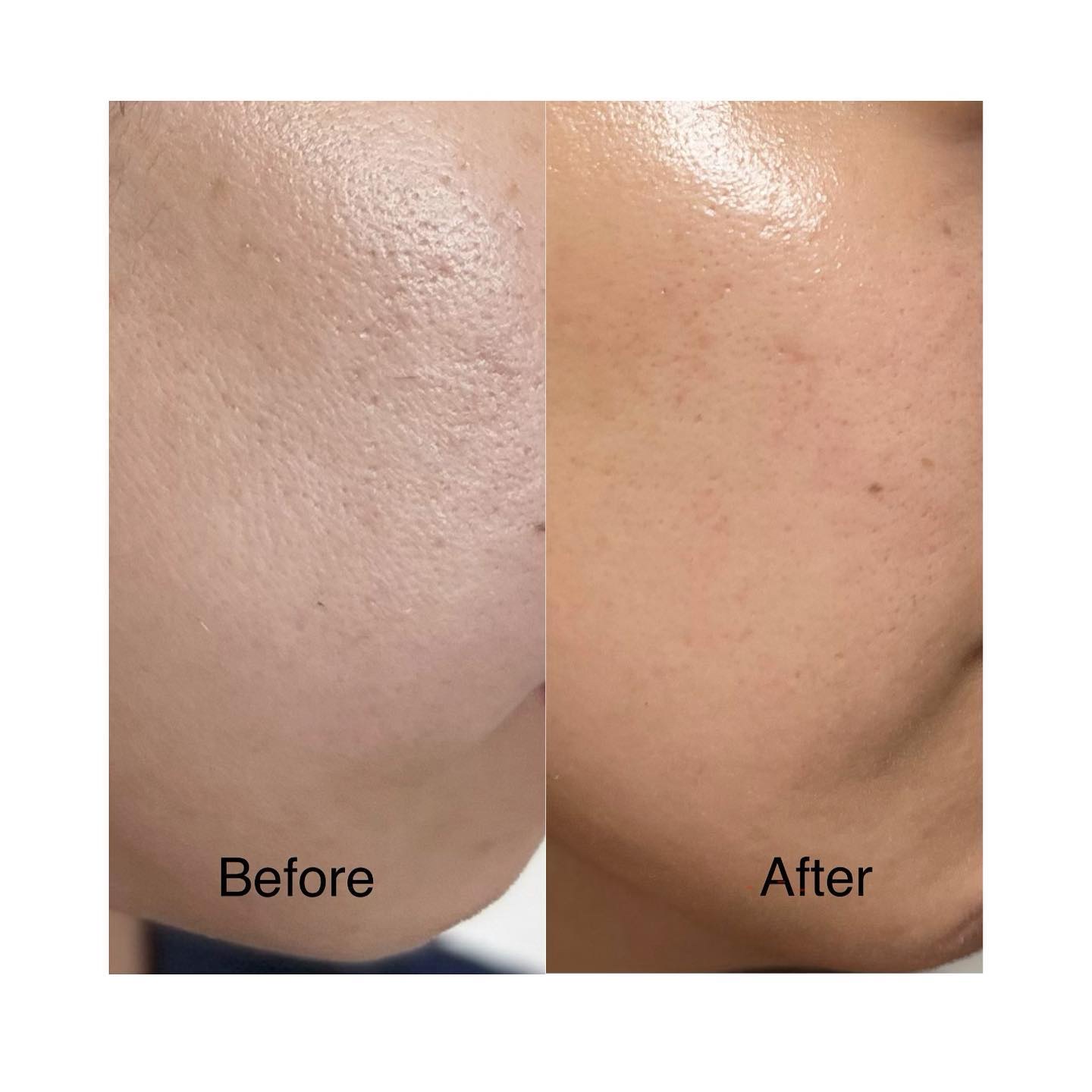 ダーマスキンピーリング/BQCELL/その他キットセットを使ったクチコミ（3枚目）