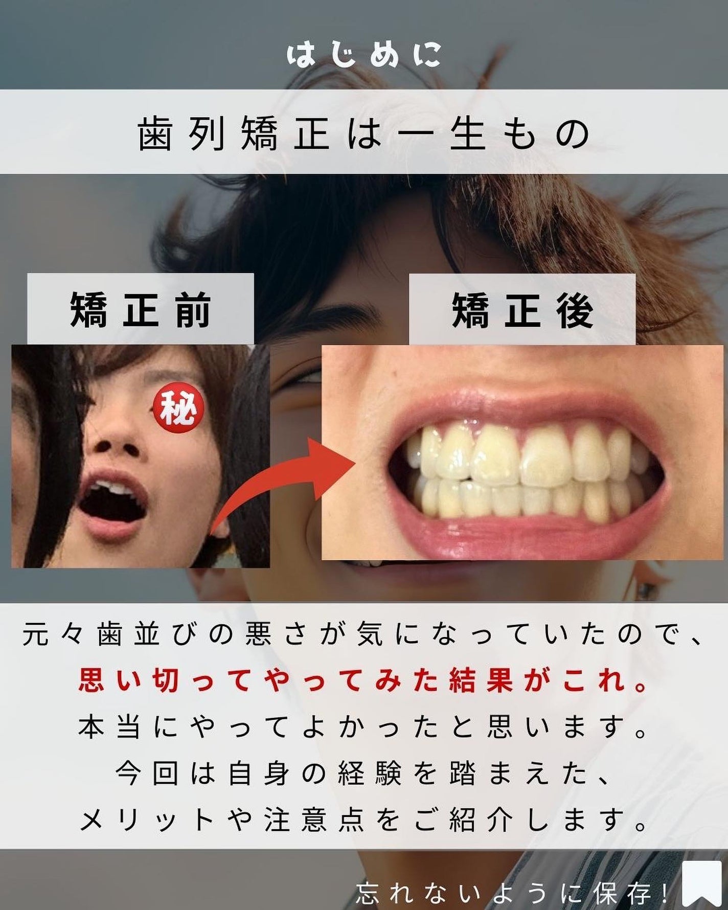 ヨウ | 31歳の老けない暮らし on LIPS 「今回は歯列矯正のメリット、注意点をご紹介します。僕は元々歯並び..」(2枚目)