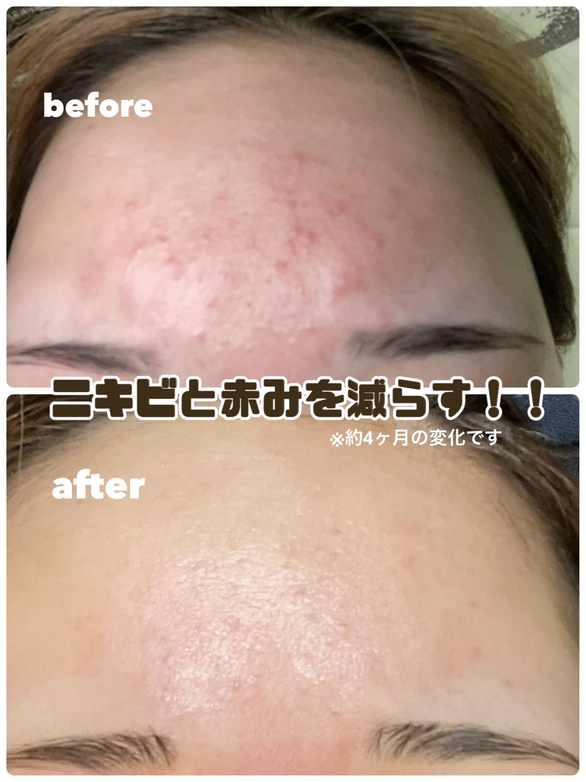 薬用パウダー化粧水/メンソレータム アクネス/化粧水を使ったクチコミ（1枚目）