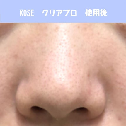 ルルルン クレンジングバーム(アロマタイプ)/ルルルン/クレンジングバームを使ったクチコミ(5枚目)