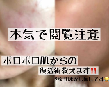 WELEDA カレンドラ ケアクリームのクチコミ「2枚目ぼかし無しのため閲覧注意して下さい。

✔ヴェレダ カレンドラ ケアクリーム
     .....」（1枚目）