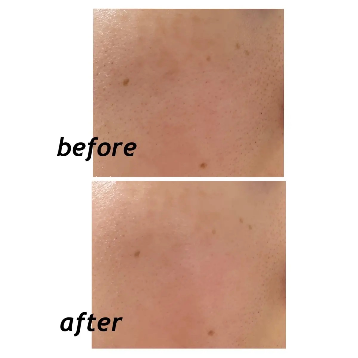 プロCICAリードルショット100/VT/ブースター・導入液を使ったクチコミ（2枚目）