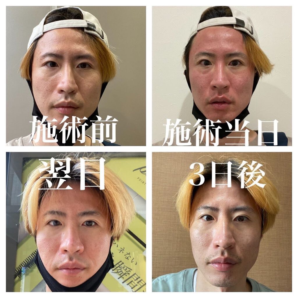 junjun_hair_make on LIPS 「フラクショナルレーザー治療✨1年ぶりに。施術中も痛くて初めて行..」(2枚目)