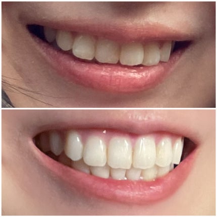 kaorico on LIPS 「.マウスピース矯正のGlorySmile(グローリースマイル..」(9枚目)