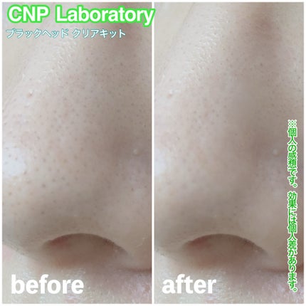 アンチポアブラックヘッドパーフェクトクリアキット/CNP Laboratory/シートマスク・パックを使ったクチコミ(4枚目)