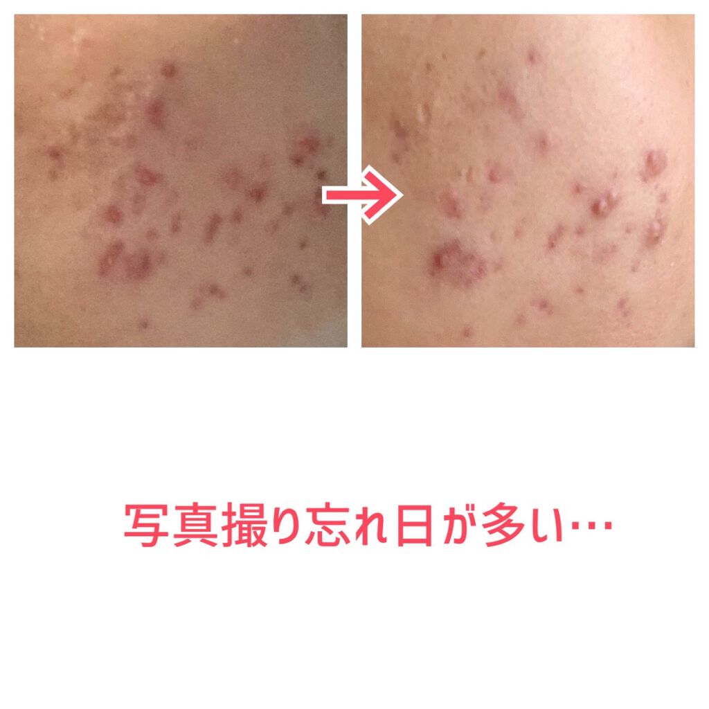 薬用保湿化粧水/オードムーゲ/化粧水を使ったクチコミ（3枚目）