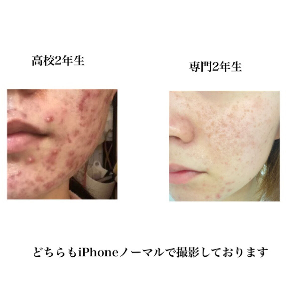 ノブ Ａ アクネソープ/NOV/洗顔石鹸を使ったクチコミ（2枚目）