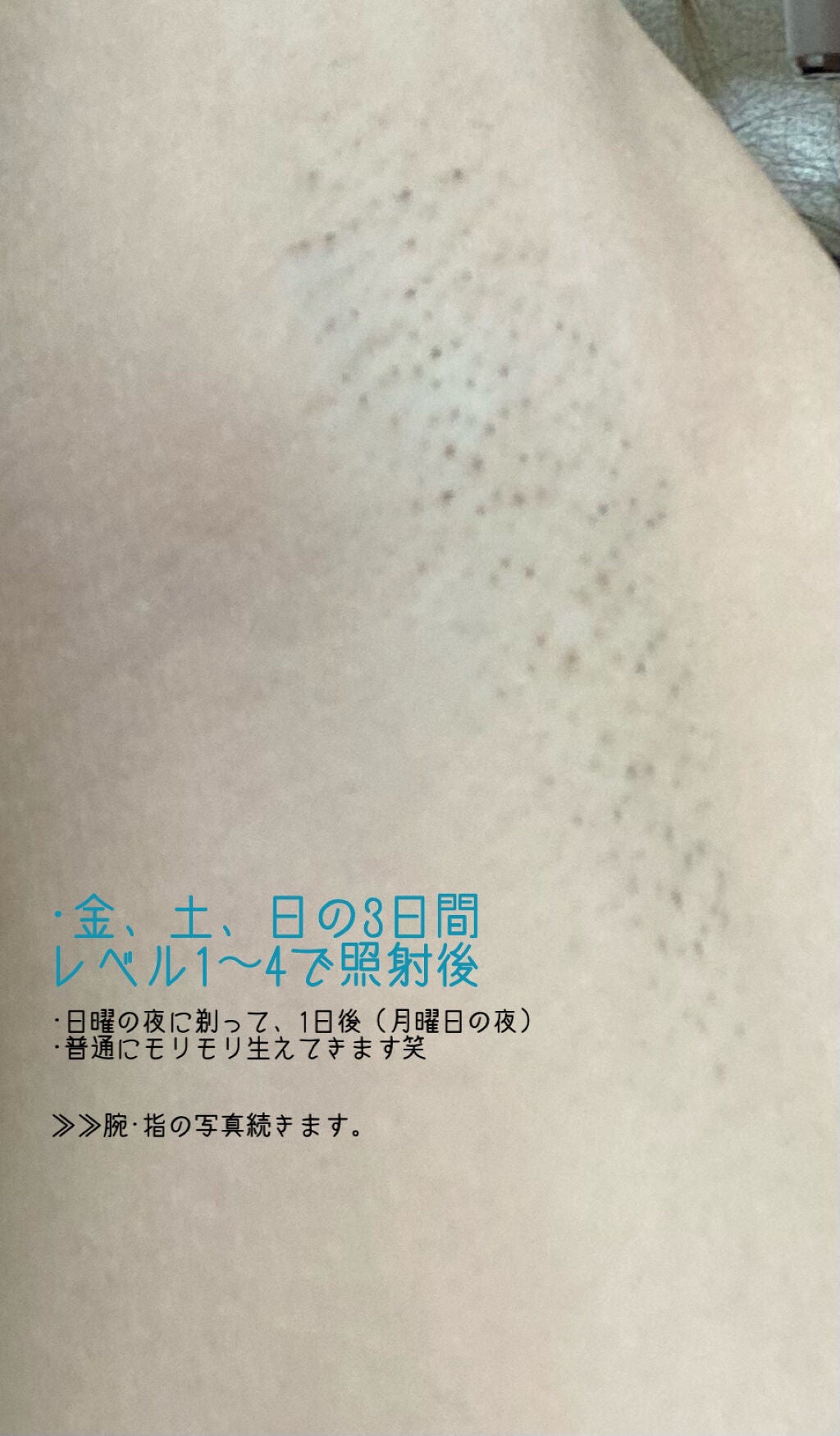 アイスレディ/icelady/家庭用脱毛器を使ったクチコミ(2枚目)