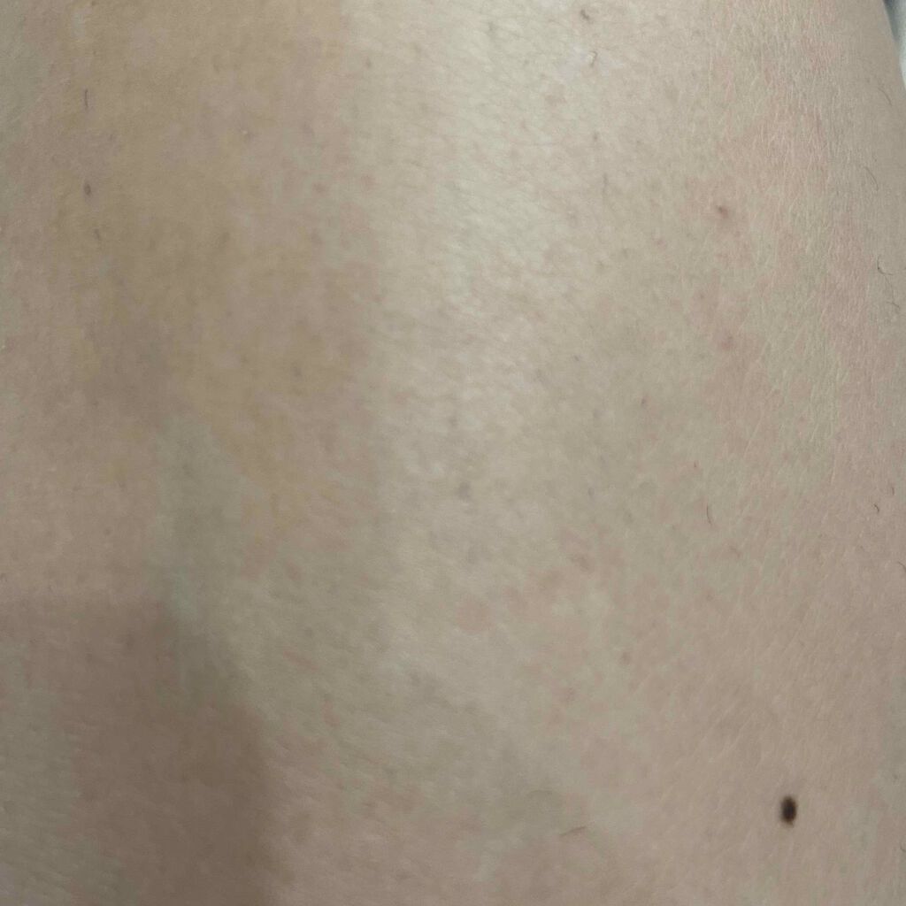 アイスレディ/icelady/家庭用脱毛器を使ったクチコミ（2枚目）