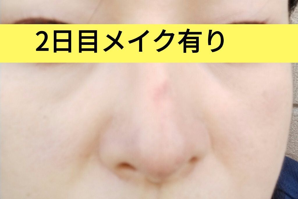 ダーマペン・ダーマスタンプ/MyM/その他スキンケアグッズを使ったクチコミ(4枚目)