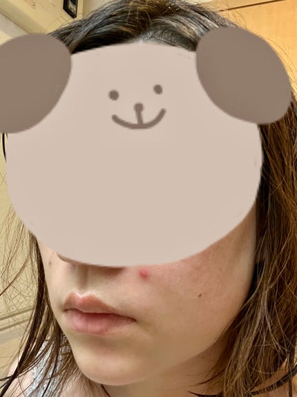 ティーツリーカーミングスポットパッチ/MEDIHEAL/その他スキンケアを使ったクチコミ(2枚目)