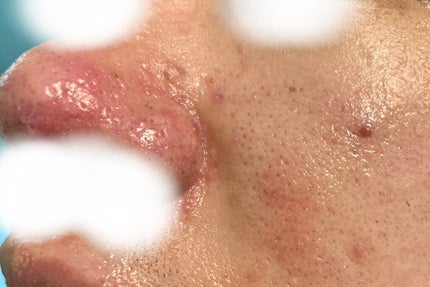 (フォロバ)3年後に韓国美男子 on LIPS 「CICA✖️HYALON使用枚数:3枚目お肌の調子はニキビ、毛..」(4枚目)