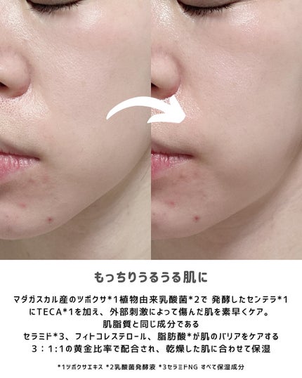 プロバイオシカ インテンシブ アンプル/SKIN1004/美容液を使ったクチコミ(4枚目)