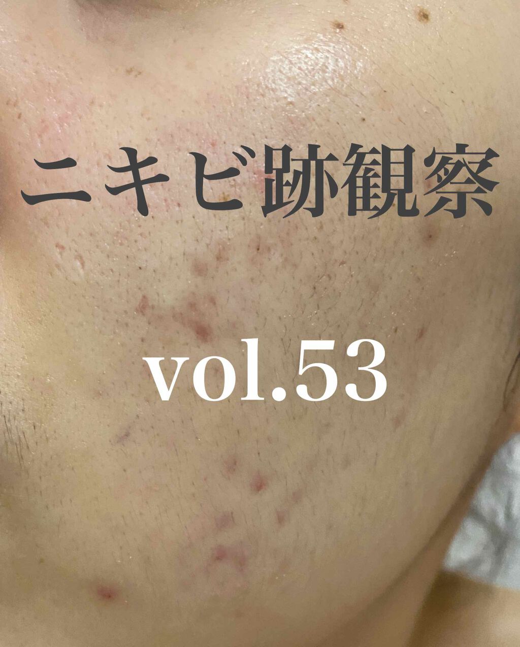 イオウカンフルローション(医薬品)/東豊薬品/その他を使ったクチコミ（1枚目）