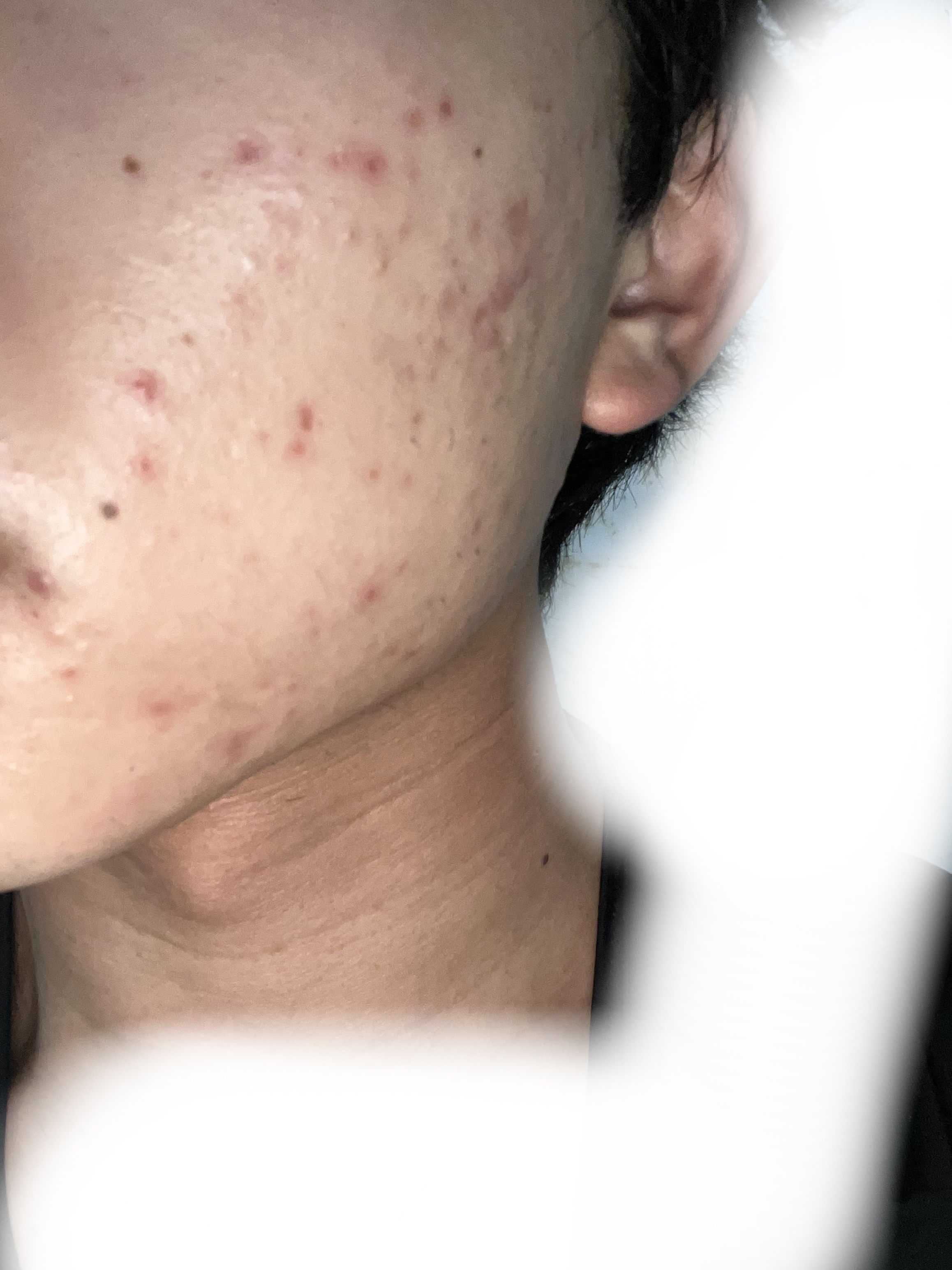 スキンピールバー ティートゥリー/サンソリット/洗顔石鹸を使ったクチコミ（1枚目）