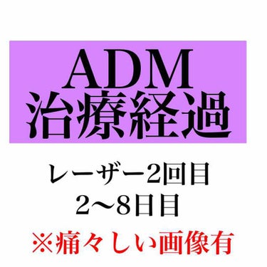 【ADM治療経過レーザー2回目　2〜8日目】

1週間ちょっと過ぎてしまいましたが、経過です。

早速様子から見てください。
［画像2枚目］

見た感じがとても痛々しいですね。
そしてぱっと見じゃ違いが