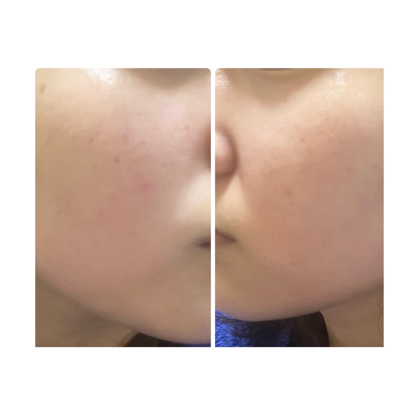 ぽむ on LIPS 「2023.9.13皮膚科に受診 エピデュオとヘパリン処方1枚目..」(5枚目)